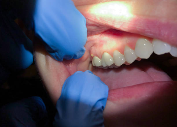 Best Emergency Treatment for Dental Infections or Abscesses in Hanahan, SC