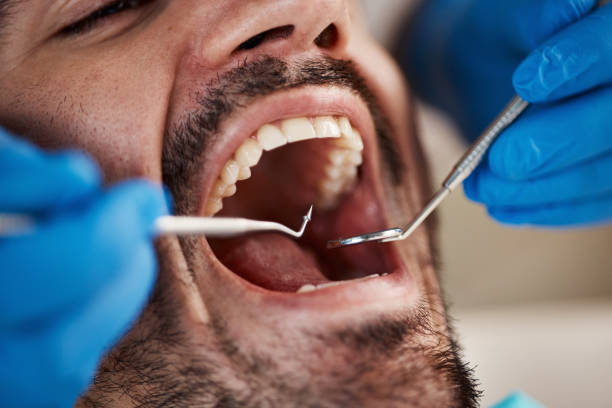 Best Emergency Root Canal Treatment in Hanahan, SC